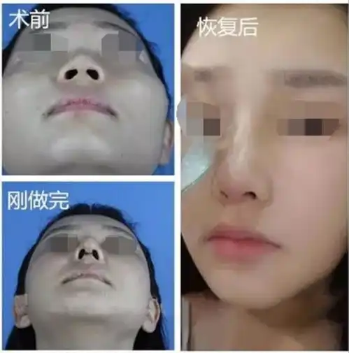 隆鼻后,不能戴眼镜

