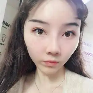鼻子不能化妆还好眼睛还是可以呢所以就只能在眼睛上做...鼻综合悦美整形
