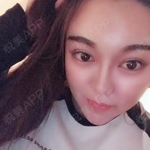术后快一个月了,恢复的越来越自然了,感觉眼睛鼻子...眼综合整形悦美整形
